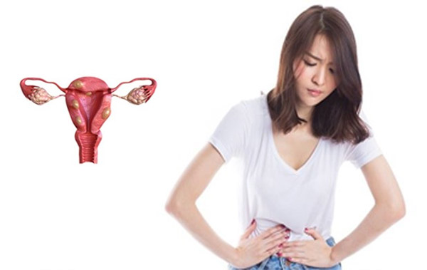Đau bụng dưới là dấu hiệu thường gặp của bệnh u xơ tử cung 